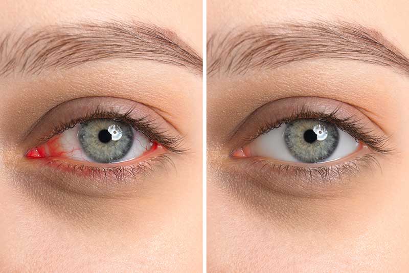 MDelite dry eye therapy